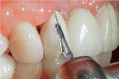 KLNK/ Porselen ve Metal Kron kesici Uzun Silindir Yuvarlak uç 5'li, Tungsten Karbid Alet FG